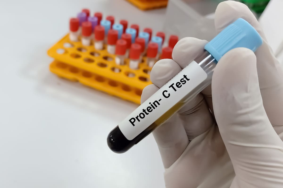 eprubetă cu sânge pentru efectuarea analizei proteina C reactivă