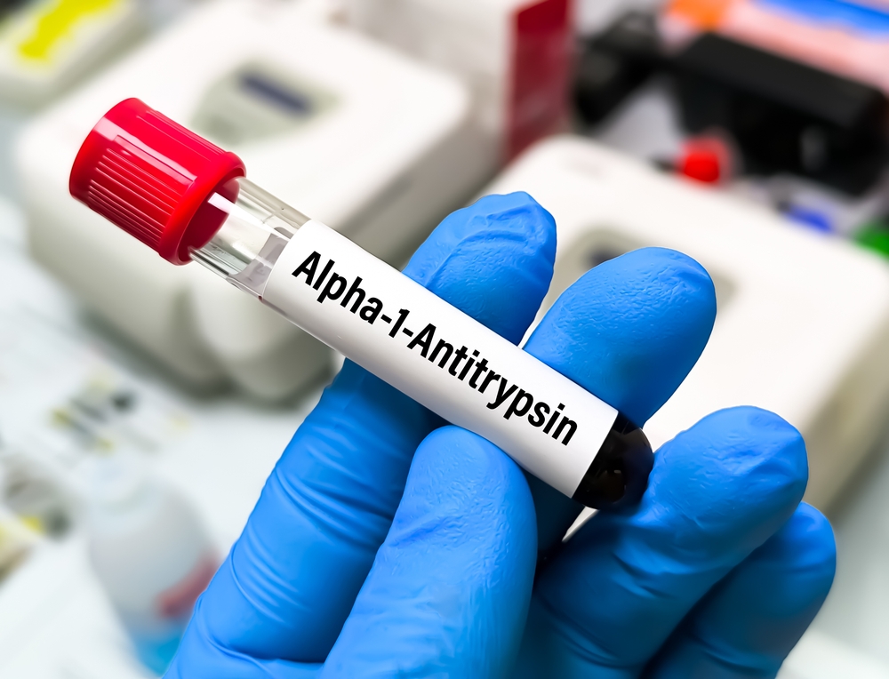 Eprubetă de sânge pentru testarea deficitului de alfa-1 antitripsină