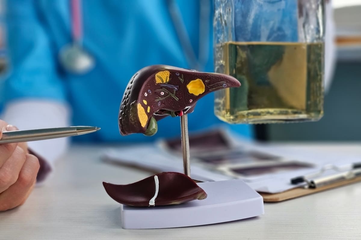 concept steatoză hepatică alcoolică