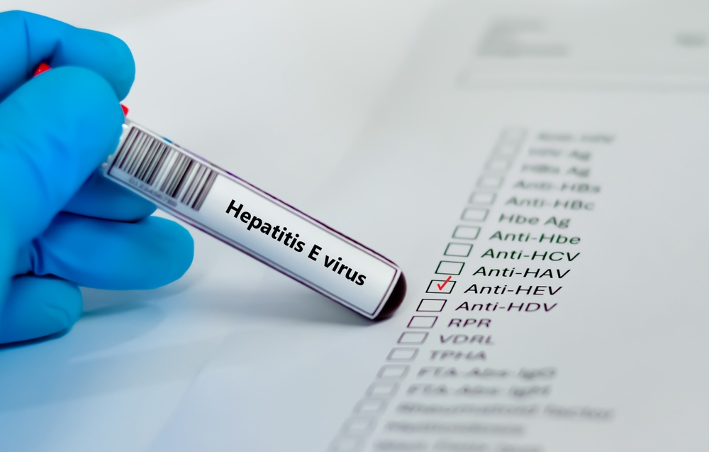 probă de sânge pentru testarea infecției cu virusul hepatitic E
