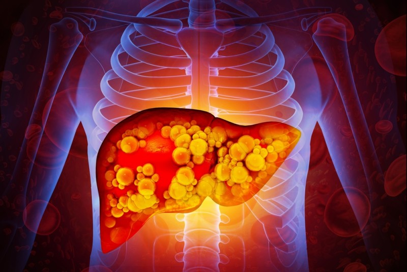 ilustratie a ficatului gras